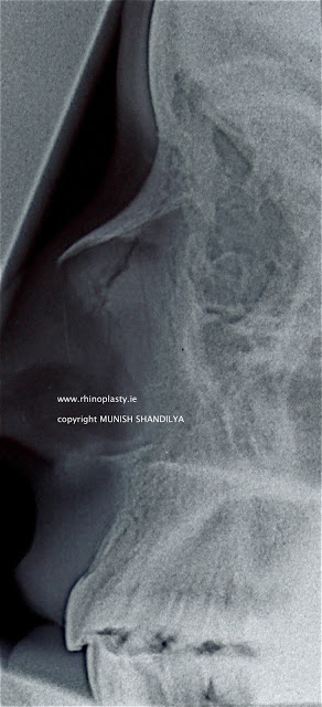 displaced-nasal-bone