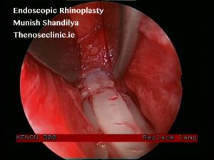 Paranasal sinus
