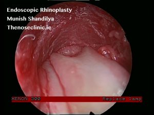 Paranasal sinus